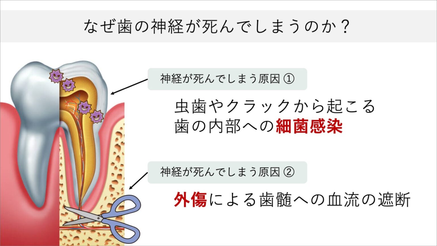 根管治療は(神経を取ると)歯がもろくなる? 歯が折れやすい原因と対策を根管治療専門医が解説