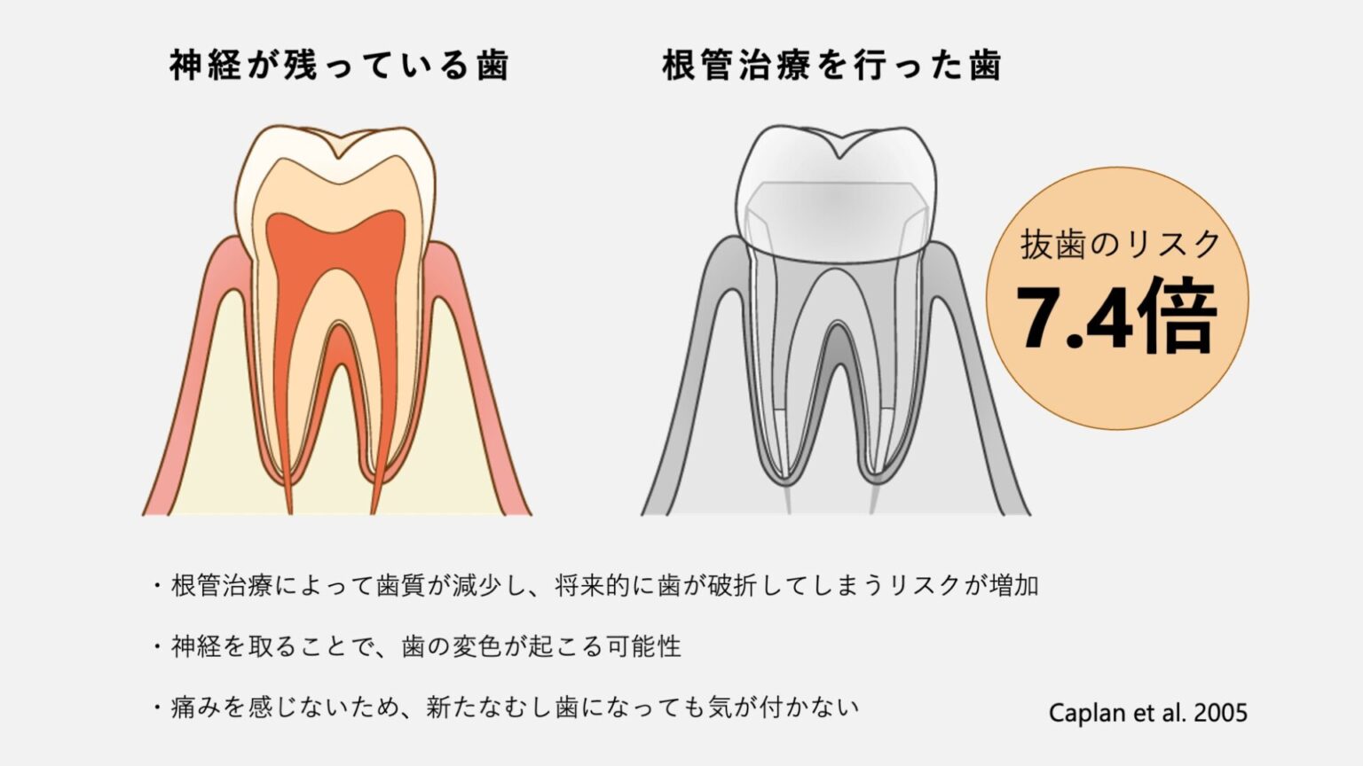 根管治療は(神経を取ると)歯がもろくなる? 歯が折れやすい原因と対策を根管治療専門医が解説