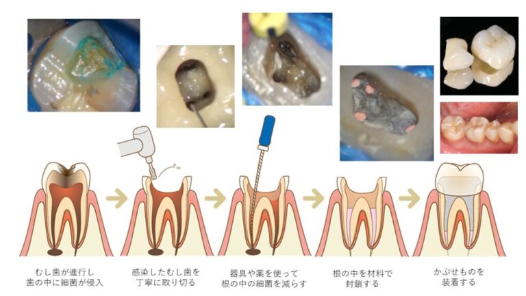 根管治療(神経を抜く治療)のデメリットとは?誤解と本当のリスクを専門医が詳しく解説