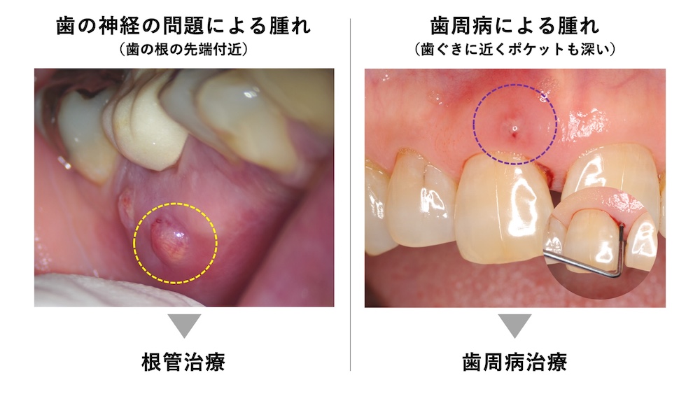 ②歯ぐきが腫れる・膿が出る