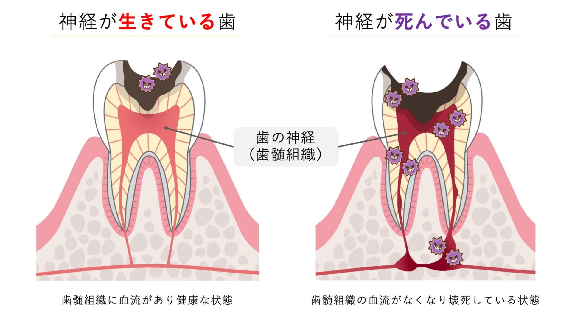神経が死んだ歯を放置するとどうなる?リスクと治療法をわかりやすく解説 | 大阪で根管治療(歯の神経の治療)なら「髙井歯科クリニック」