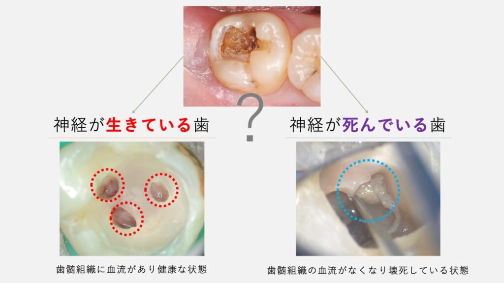 歯の神経が死んでいるかを判断する方法