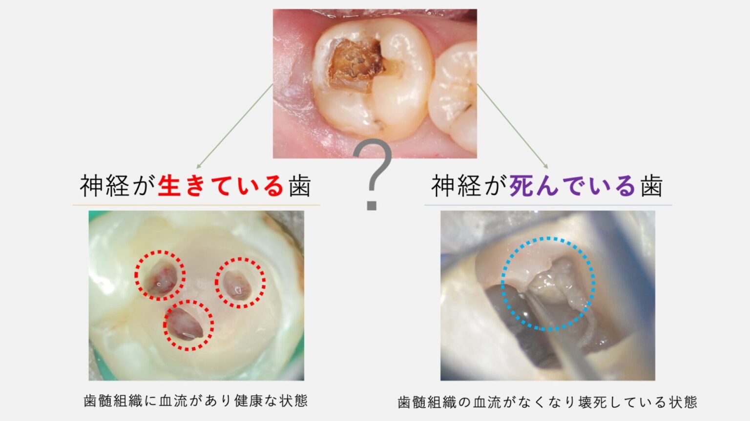 神経が死んだ歯を放置するとどうなる?リスクと治療法をわかりやすく解説 | 大阪で根管治療(歯の神経の治療)なら「髙井歯科クリニック」