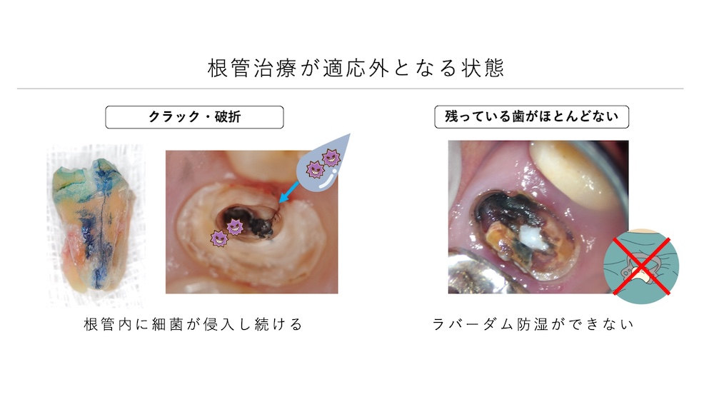 歯を保存できない場合は抜歯となることも