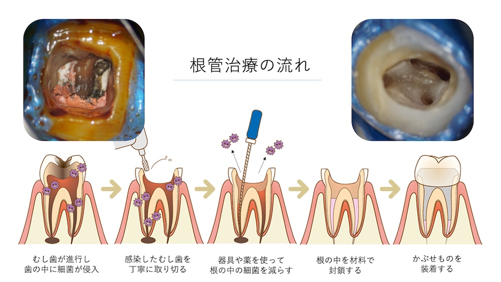 具体的な治療:細菌に感染した神経を除去し、根の中を清掃・封鎖する