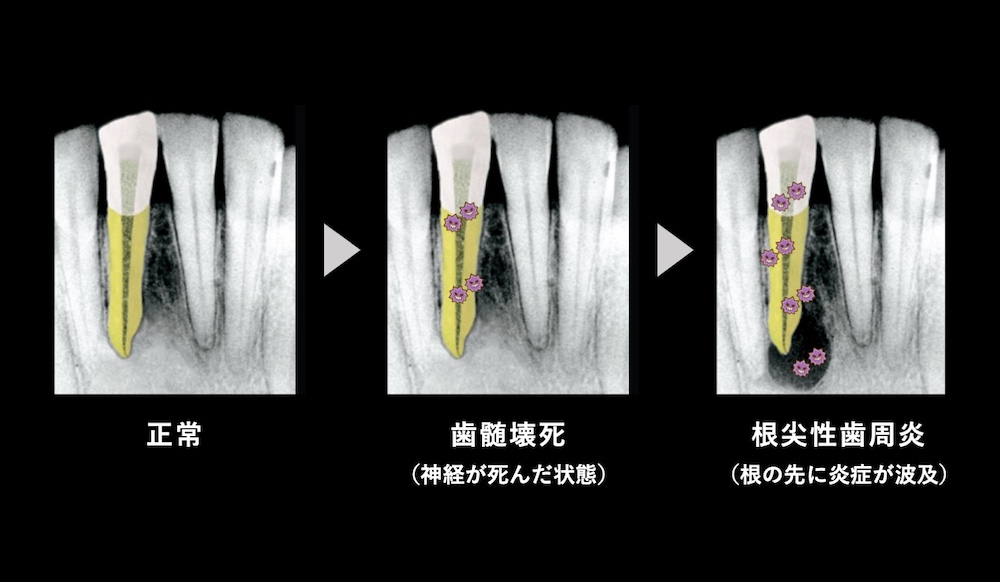 ①根の先に膿がたまり炎症が広がる