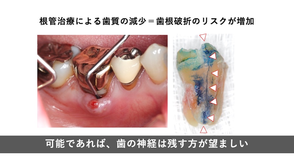 根管治療による歯質の減少＝歯根は説のリスクが増加
可能であれば、歯の神経は残す方が望ましい