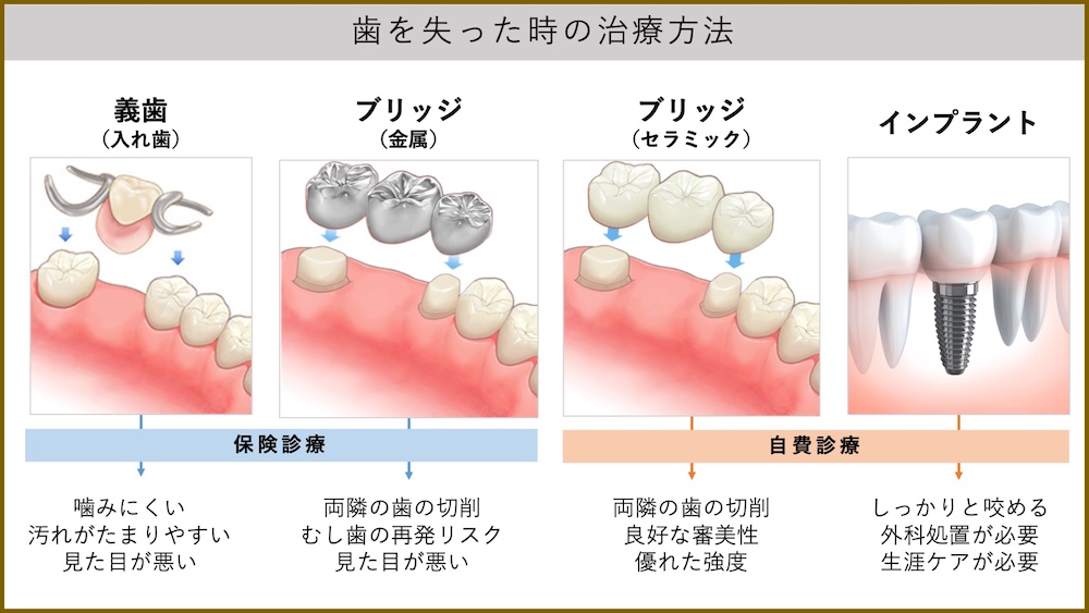 歯を失った時の治療方法。
保険診療が適応できるのは義歯と金属のブリッジ。義歯は噛みにくく汚れが溜まりやすい、見た目が悪いなどのリスクが、金属製のブリッジは両隣の歯の切削が必要、虫歯の再発リスクが高い、見た目が悪いといったリスクがあります。
自費治療ではセラミックのブリッジとインプラント。セラミックブリッジは両隣の歯の切削が最小限で済む点や良好な審美性、優れた強度といった利点があります。インプラントについてはjしっかりと咬める点が大きなメリットです。ただし外科処置が必要だったり、生涯ケアが必要になる点には注意が必要です。