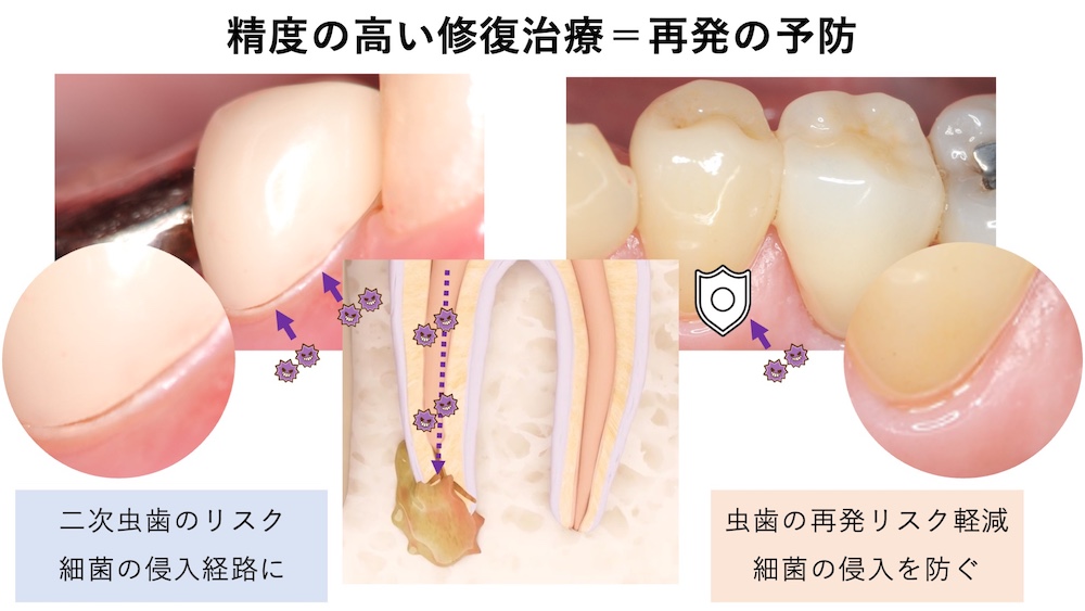 精度の高い修復治療＝再発の予防
精度の低い修復治療では、二次虫歯のリスクが高く細菌の侵入経路になってしまいます。
精度の高い修復治療は細菌の侵入を防ぎ虫歯の再発リスクが軽減します。