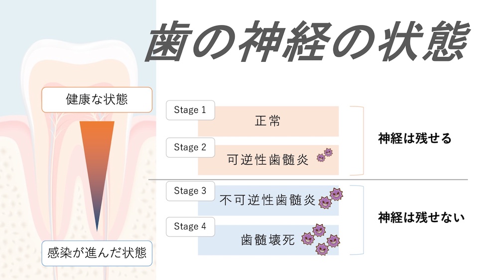 歯の神経の状態、健康な状態〜感染が進んだ状態。
正常や可逆性歯髄炎の状態なら神経を残せるが、不可逆性歯髄炎や歯髄壊死が起きていると神経は残せない、。