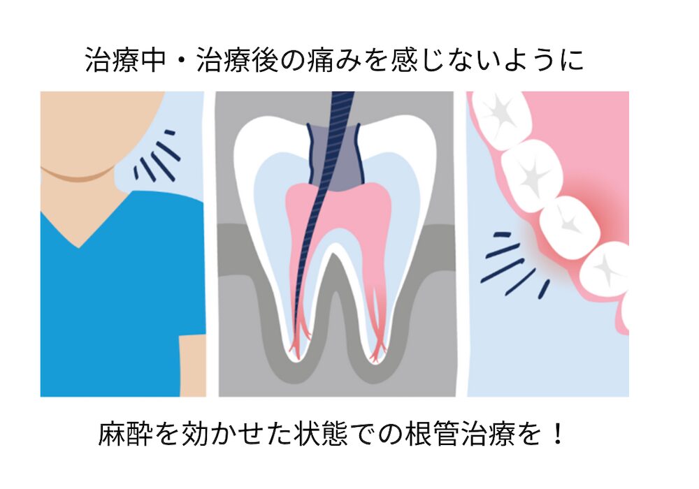 治療中・治療後の痛みを感じないように。麻酔を効かせた状態での根管治療を！
