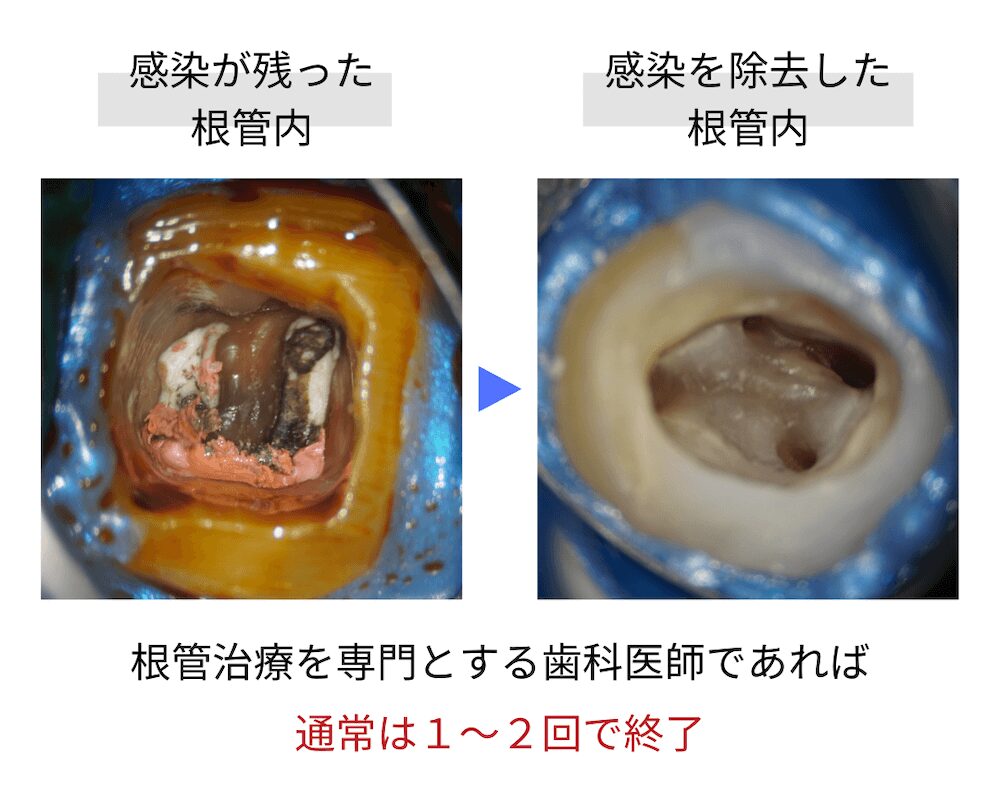 感染が残った根管内と感染を除去した根管内の比較。根管治療を専門とする歯科医師であれば通常は1回〜2回で治療が終了します。