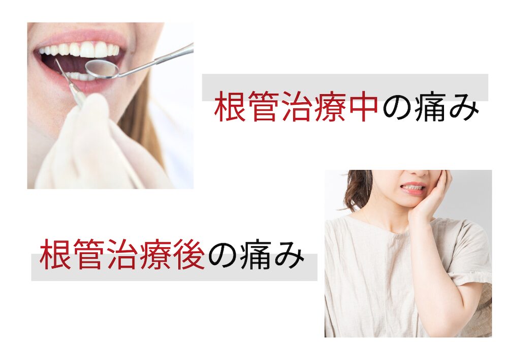 歯の神経を抜くのは痛い？治療中・治療後の痛みと適切な対処法を解説