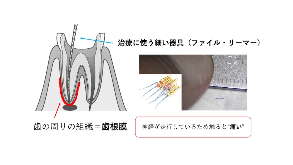 治療に使う細い器具（ファイル・リーマー）
歯の周りの組織＝歯根膜。神経が走行しているため触ると痛い