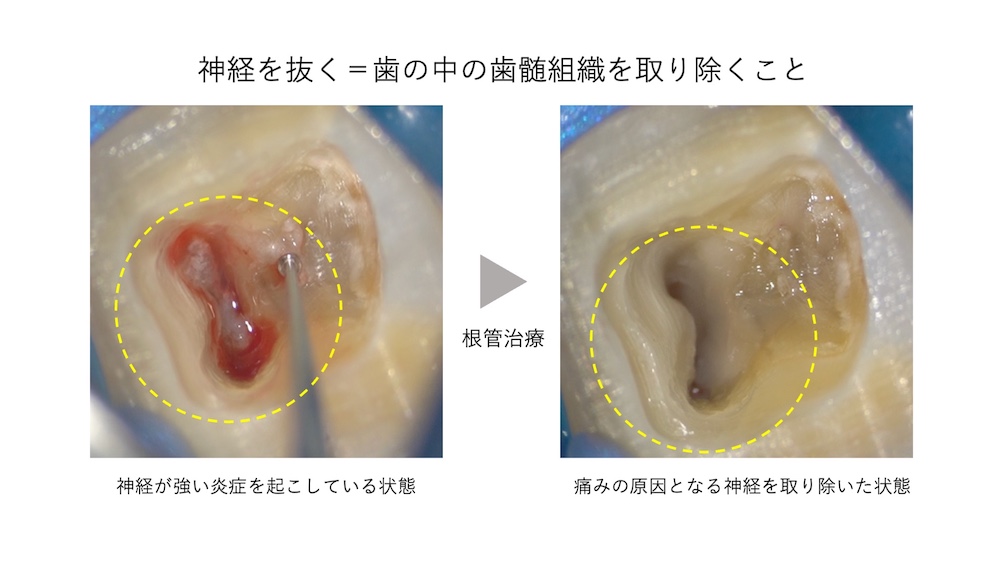 そもそも「歯の神経を抜く」とは
神経を抜く＝波の中の歯髄組織を取り除くこと。根管治療、神経が強い炎症を起こしている状態。痛みの原因となる神経を取り除いた状態。