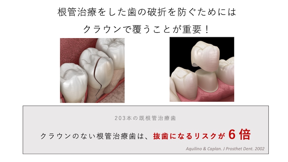 根管治療をした歯の破折を防ぐためにはクラウンで覆うことが重要！
203本の既根管治療歯を調査したところ、クラウンの無い根管治療歯は抜歯になるリスクが6倍高いことがわかっています。