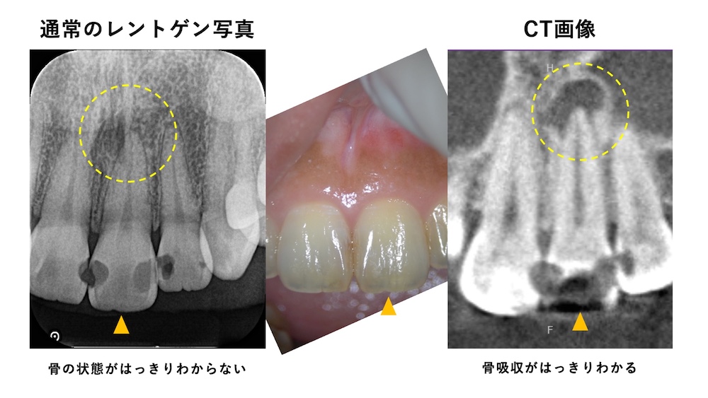通常のレントゲン写真：骨の状態がはっきりわからない。
CT画像：骨吸収がはっきりわかる。