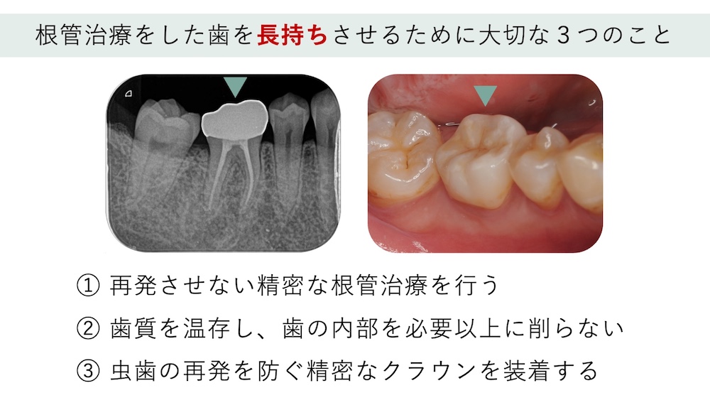 根管治療をした歯を長持ちさせるために大切な３つのこと。
①再発させない精密な根管治療を行う。
②歯質を温存し、歯の内部を必要以上に削らない。
③虫歯の再発を防ぐ精密なクラウンを装着する。