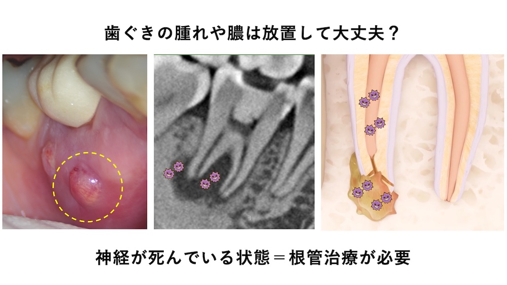 歯茎の腫れや膿は放置して大丈夫？神経が死んでいる状態＝根管治療が必要
