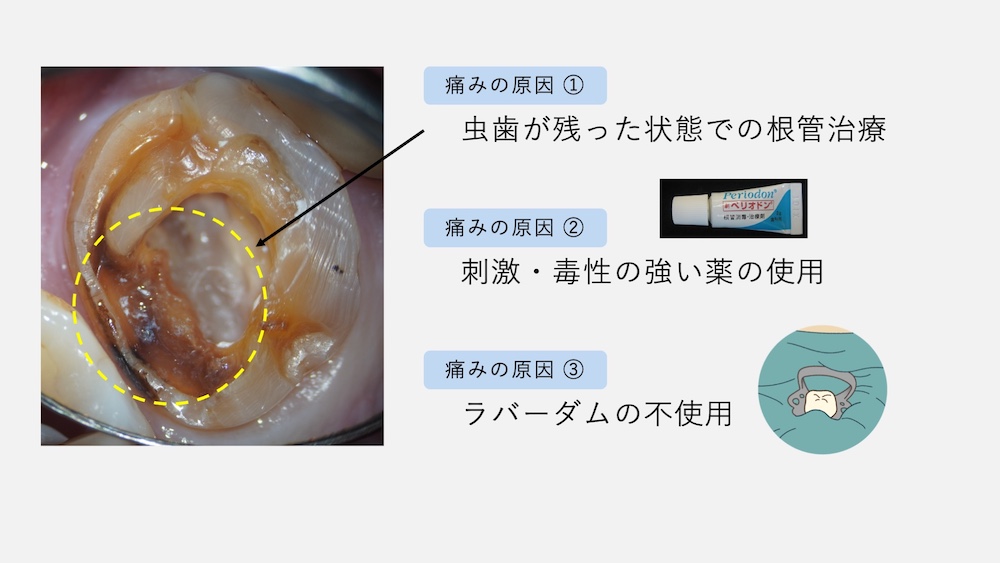 痛みの原因①虫歯が残った状態で根管治療
痛みの原因②刺激・毒性の強い薬の使用
痛みの原因③ラバーダムの不使用