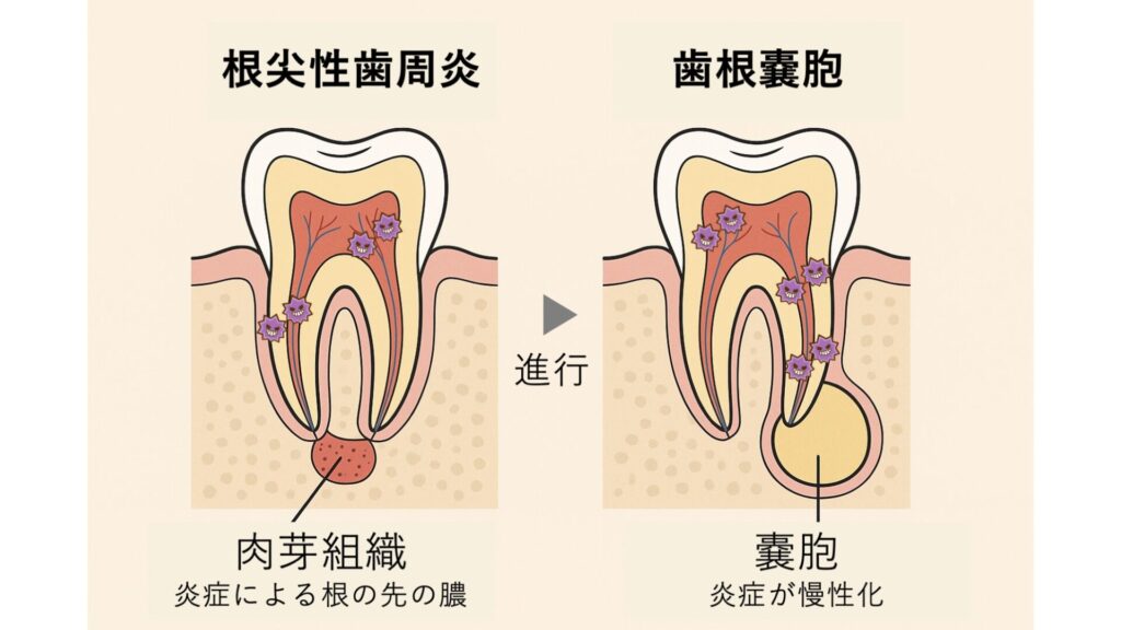歯根嚢胞の原因