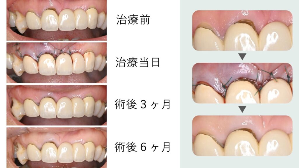 術後の痛みや腫れなどのケアについて