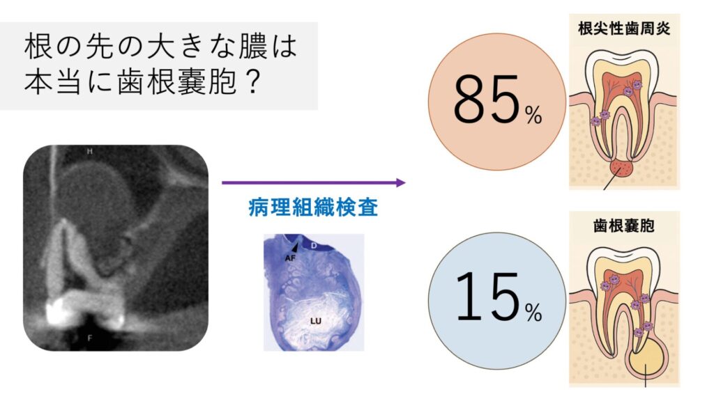 膿の大きさと嚢胞の有無は一致しない