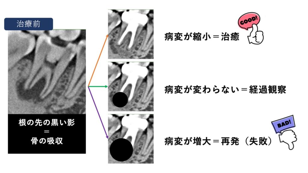 根の先の膿（嚢胞）が治る場合、その多くが１２ヶ月程度の期間を要すると言われています。そのため、まずは６ヶ月後に経過観察で来院いただき、症状の確認とCTを撮影し、治癒の状態を評価します。