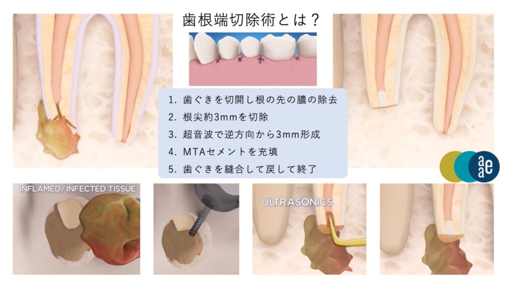 歯根端切除術とは
