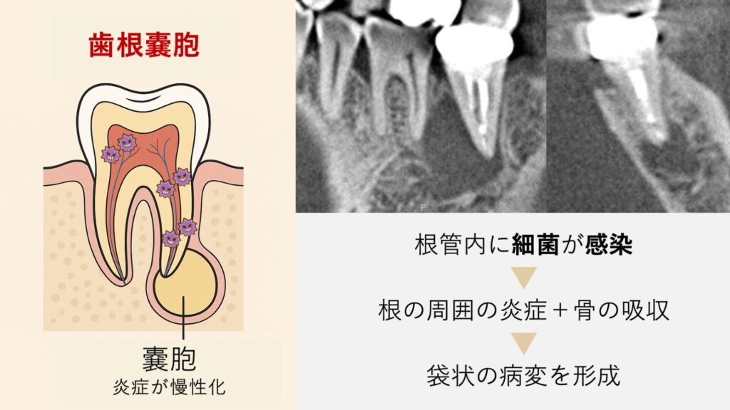 歯根嚢胞とは？