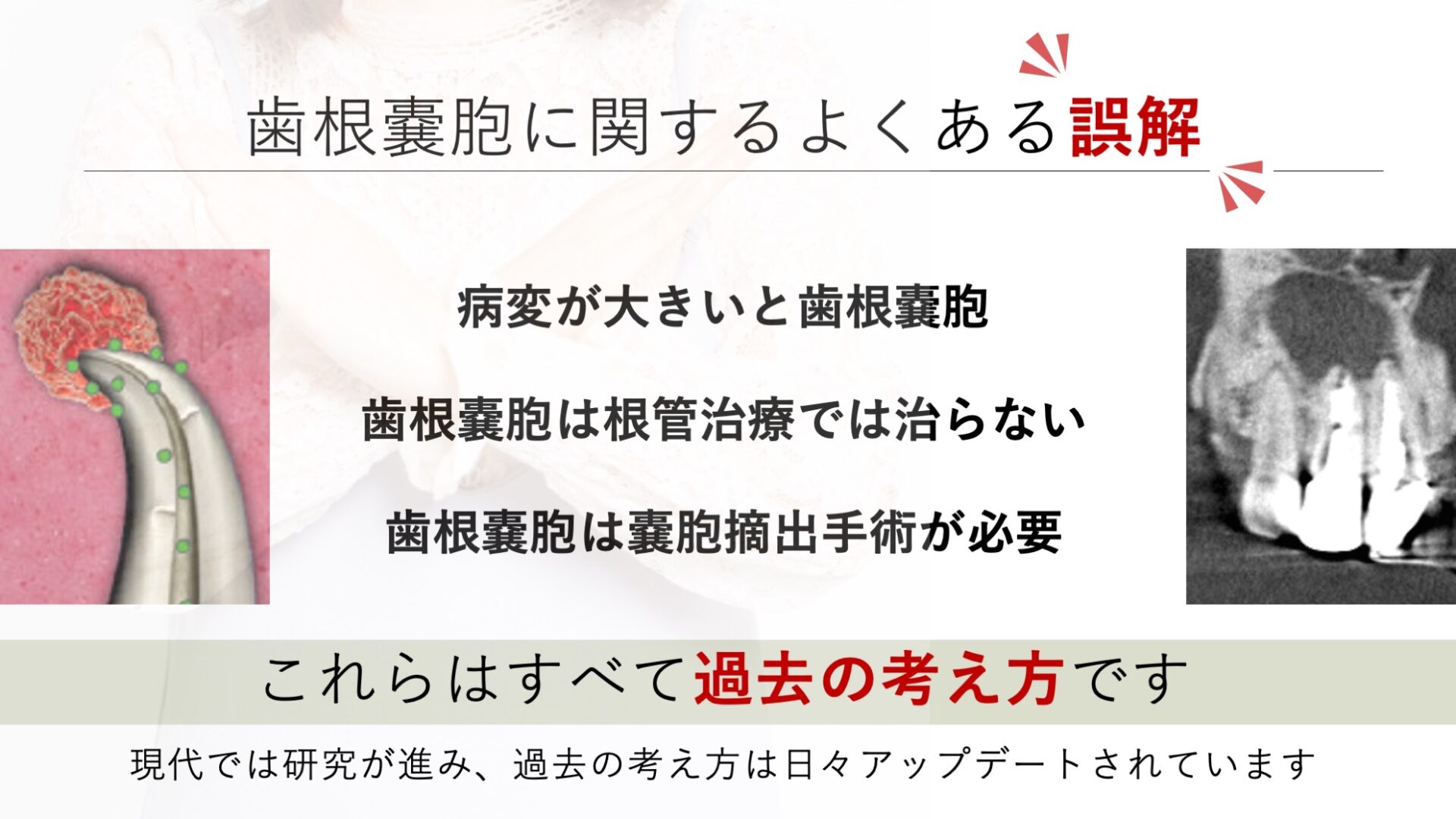 歯根嚢胞は必ず手術が必要？根管治療で治るケースと正しい診断の重要性