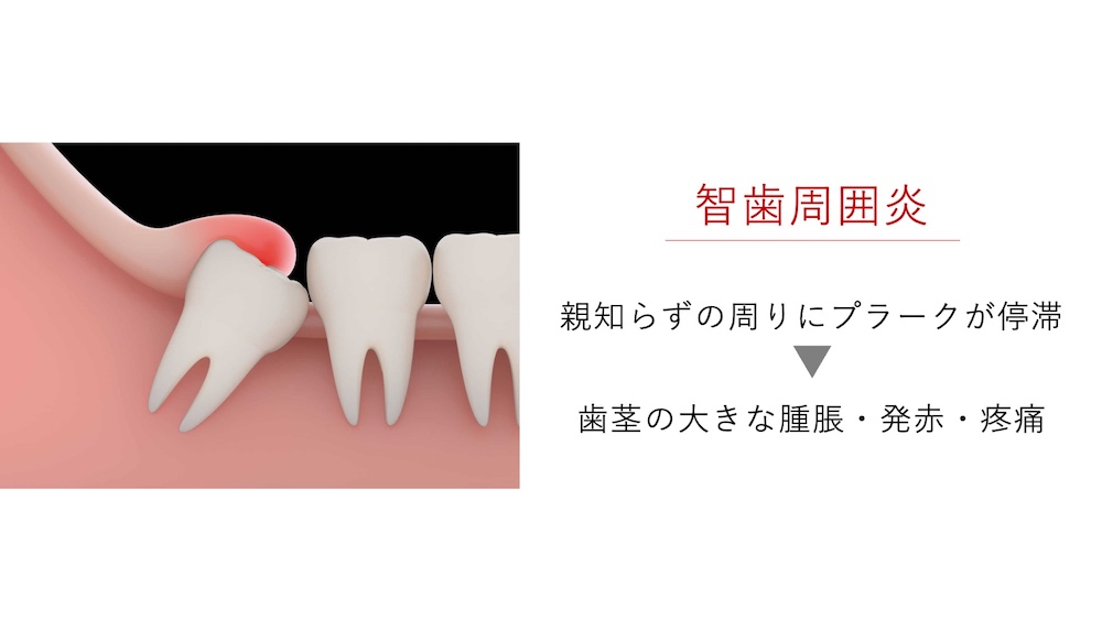 親知らず関連の炎症（智歯周囲炎）