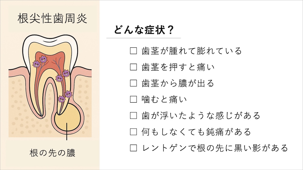 根尖性周囲炎とはどんな症状？