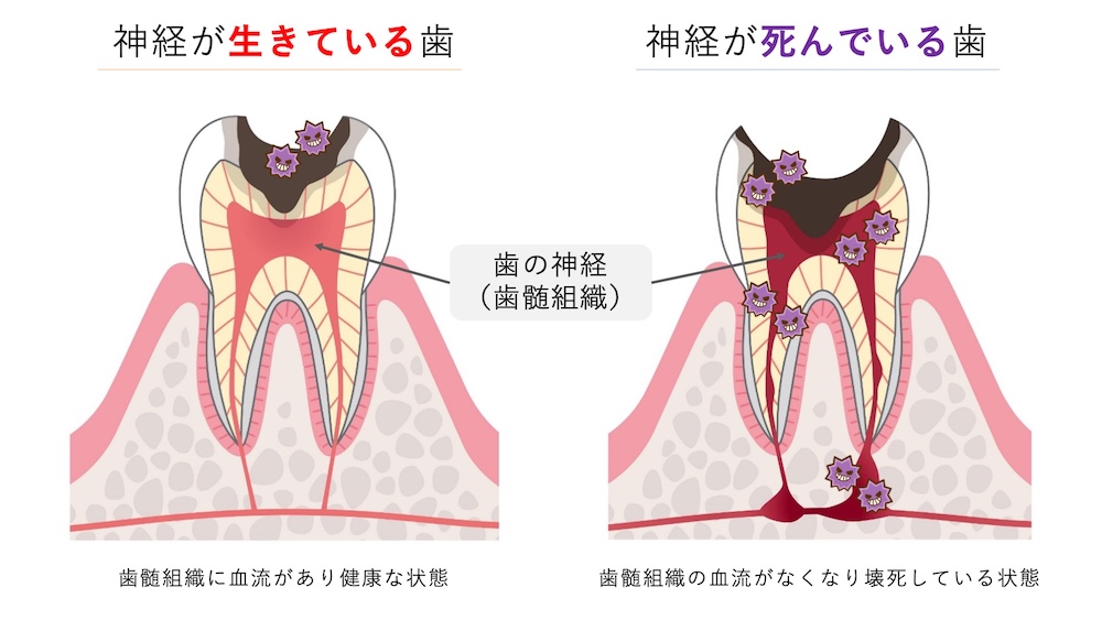神経が生きている歯と神経が死んでいる歯の比較