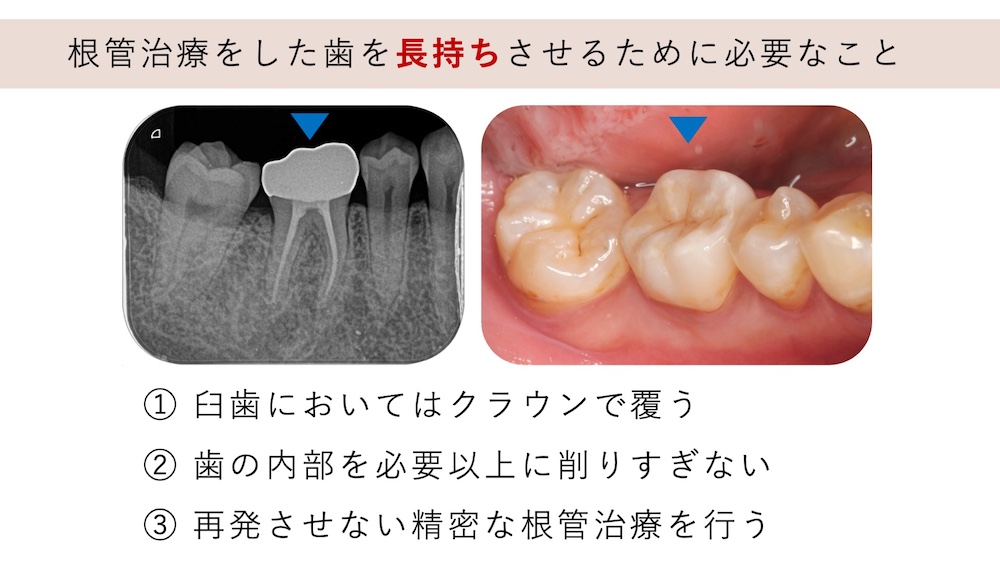 再発を防ぎ、歯を長持ちさせるための徹底した治療