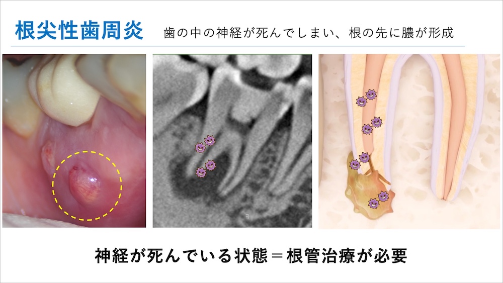根尖性歯周炎＝歯の中の神経が死んでしまい、根の先に海が形成。神経が死んでいる状態＝根管治療が必要