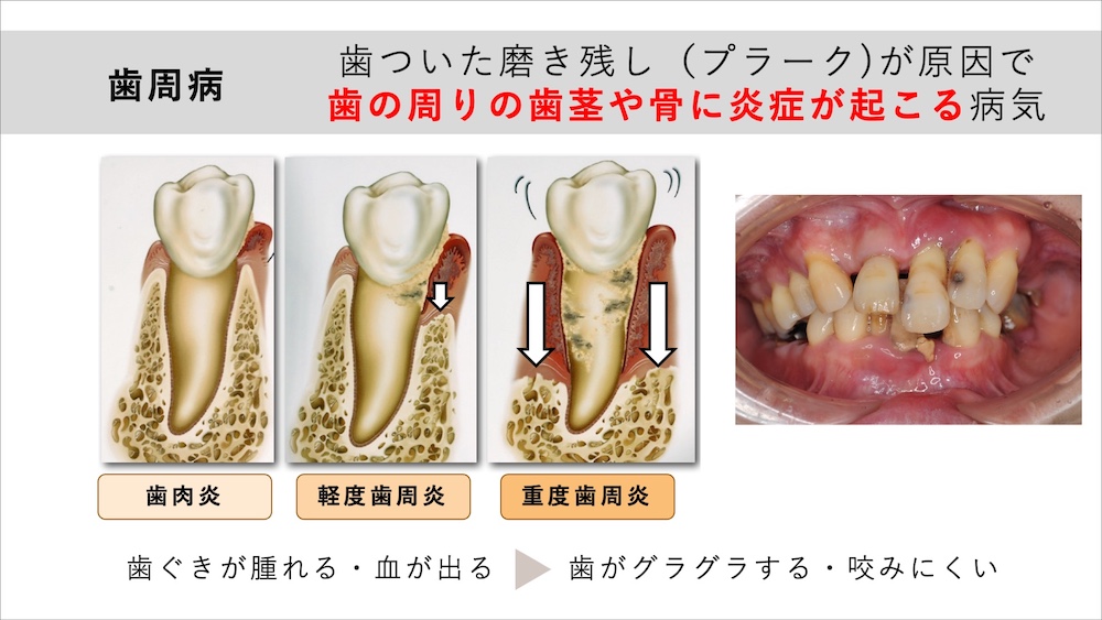 歯についた磨き残し（プラーク）が原因で歯の周りの歯茎や骨に炎症が起こる病気