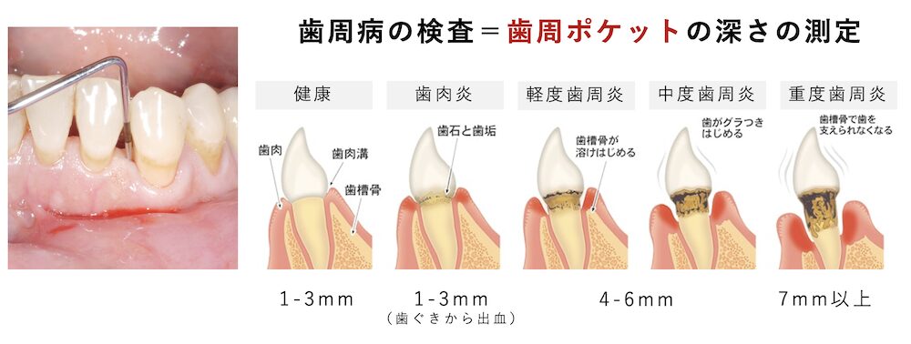 歯周病の検査＝歯周ポケットの深さの測定