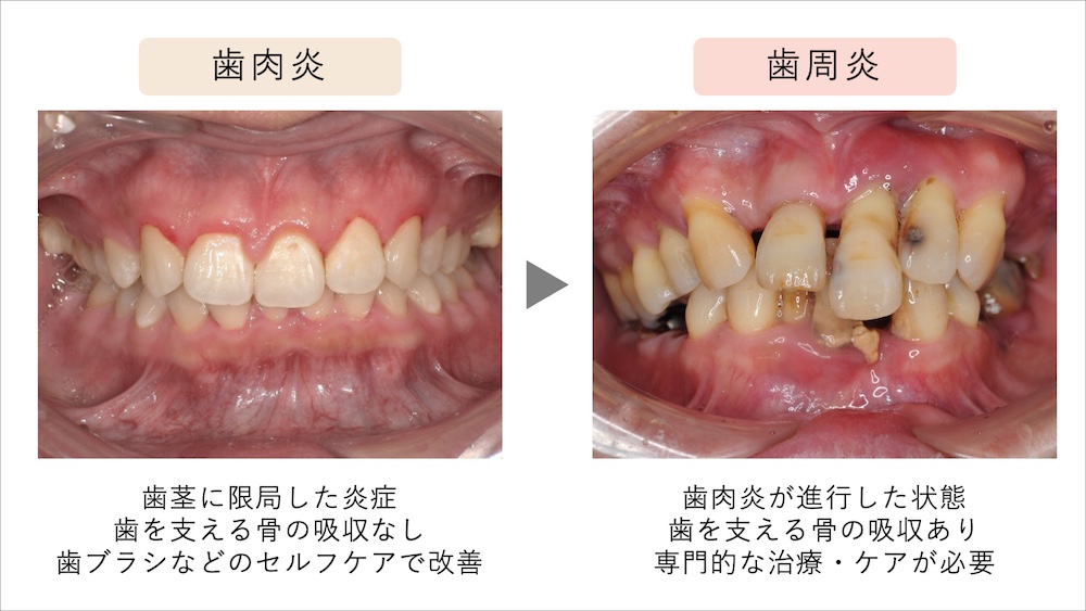 初期の歯肉炎から中等度・重度への進行の特徴