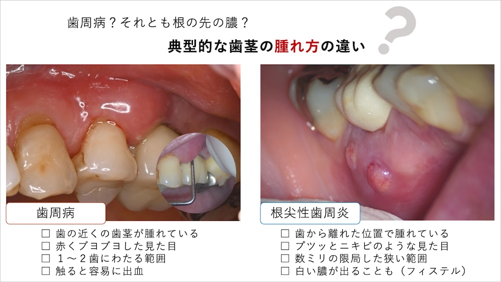 歯周病？それとも根の先の膿？典型的な歯茎の腫れ方の違い