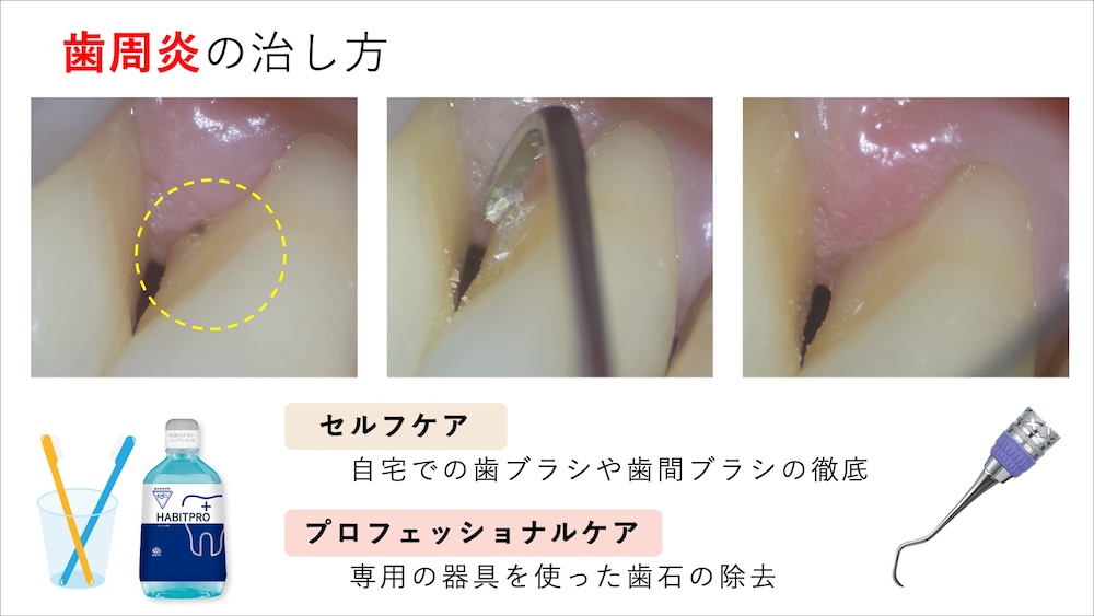 歯周炎の治療方法 