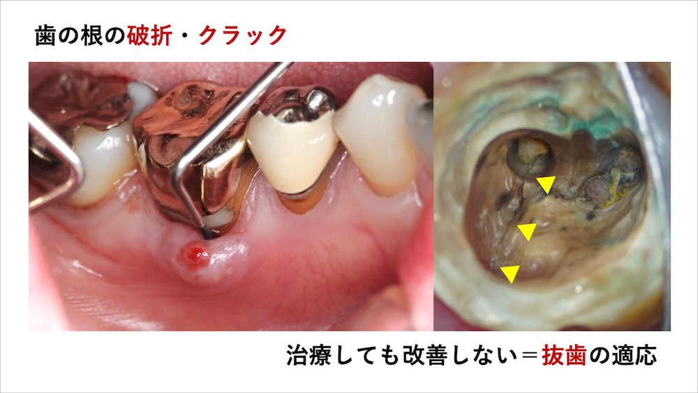 虫歯・歯根破折・非歯科的要因（非歯原性疼痛）