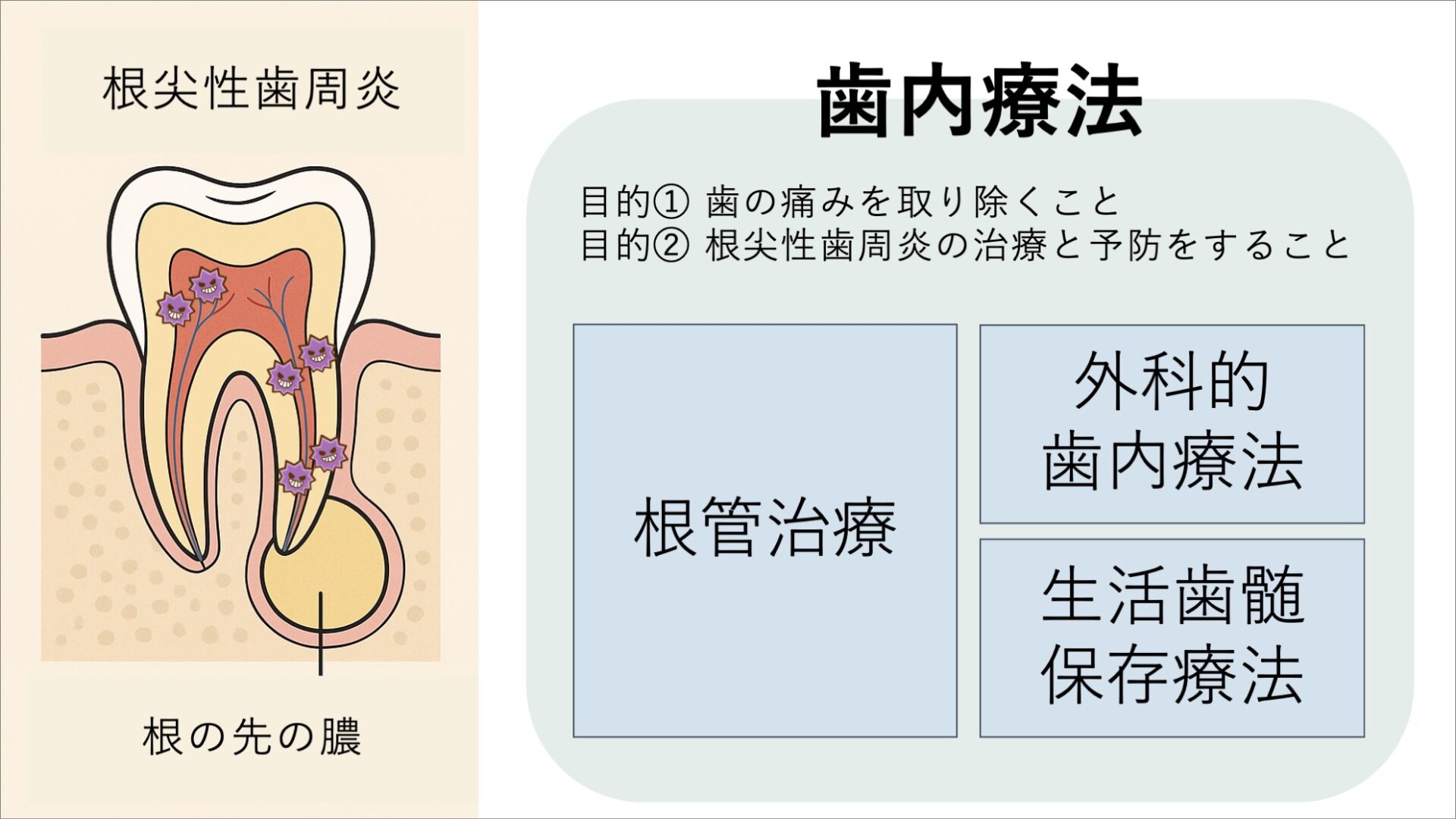 歯根端切除術とは?根の先の膿や嚢胞を取り除き、歯を残す外科的根管治療|【大阪の歯内療法専門医】
