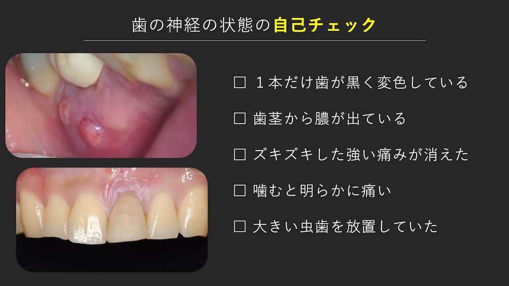 神経の状態を自己チェックできる症状・サイン
1本だけ歯が黒く変色している、歯茎から膿が出ている、ズキズキした強い痛みが消えた、噛むと明らかに痛い、大きい虫歯を放置していた