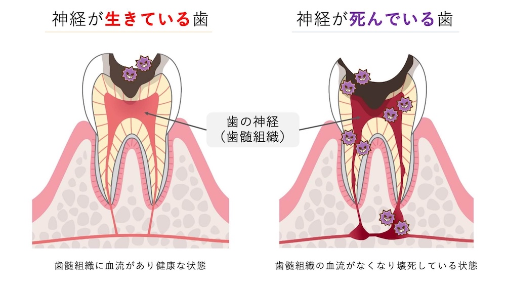 歯の神経が死んでいるとは?