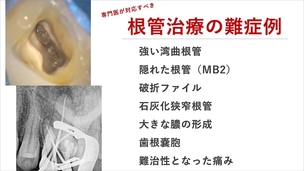 再治療を回避するための工夫