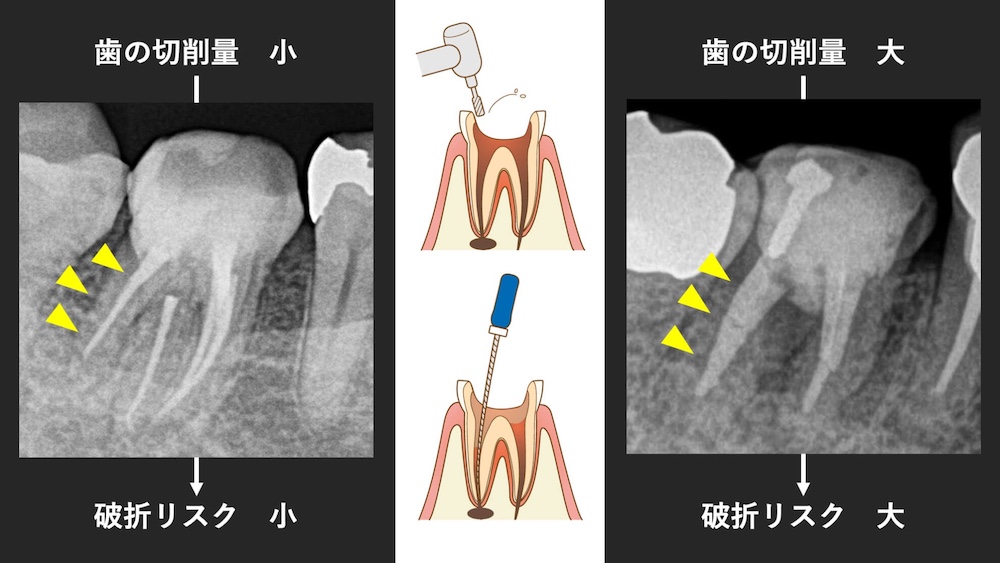 歯の切削量が少なければ歯の破折リスクも少なく、歯の切削量が多ければ歯の破折リスクも高くなる