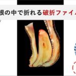 根管治療で器具が折れて針が残る「破折ファイル」とは|除去の必要性と判断基準