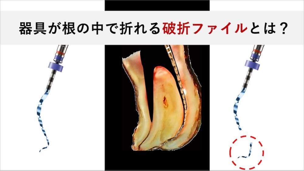 根管治療で器具が折れて針が残る「破折ファイル」とは|除去の必要性と判断基準