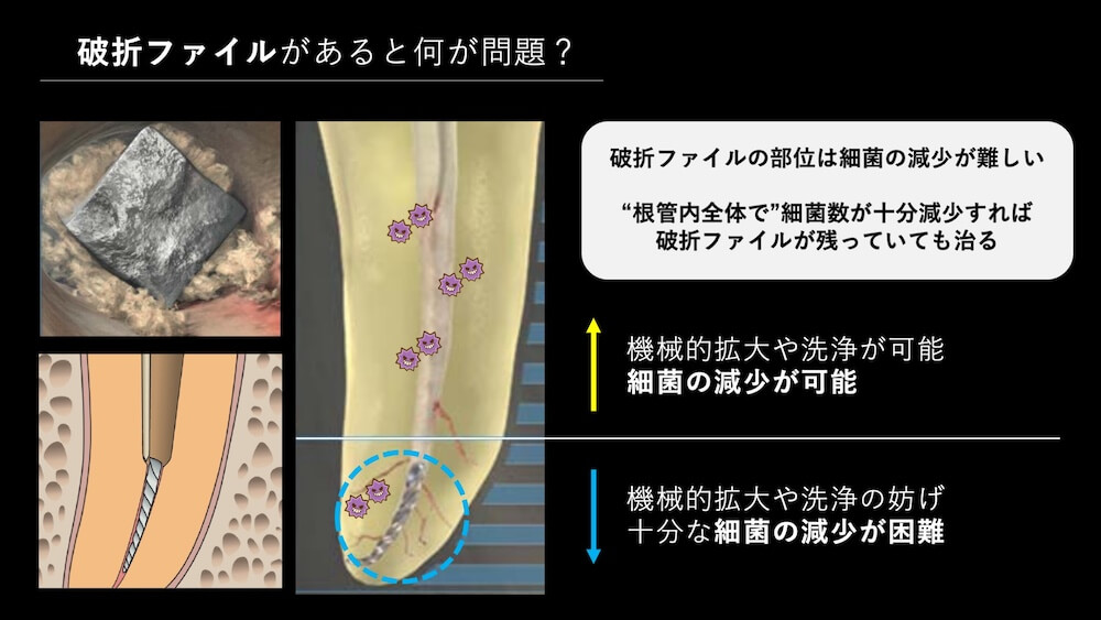 破折ファイルの問題点|再根管治療への影響